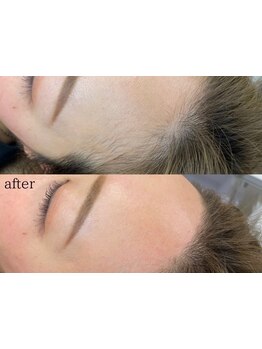 顔脱毛がしたい