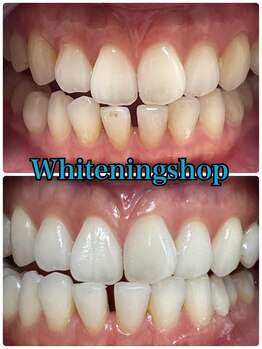 ホワイトニングショップ 山形店(Whiteningshop)/都度払いでもOK