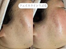 フラックス 京都(FLUX)/【ワックス脱毛】フェイシャル