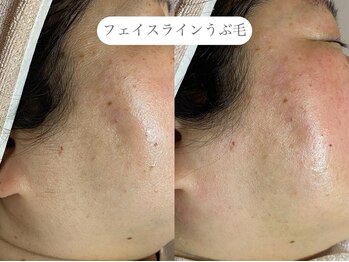 フラックス 京都(FLUX)/【ワックス脱毛】フェイシャル