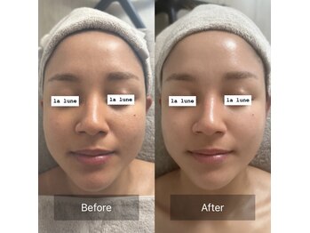 ラリュンヌ(La Lune)/毛穴開き/くすみ/浮腫/美白