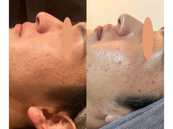 マザートウキョウ(Mother TOKYO)/凹凸ケアにも◎