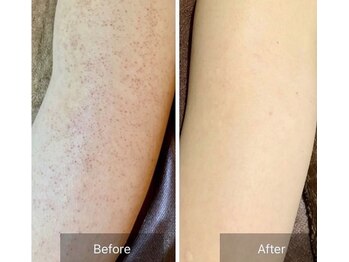 エミルカ 自由が丘店(EMILUCA)/気になるうでのぶつぶつへ