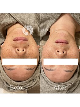 ルプレ(Lupure)/ハーブピーリング4回目