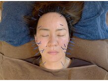 こじま 富雄団地接骨院/ヒト幹細胞美容鍼