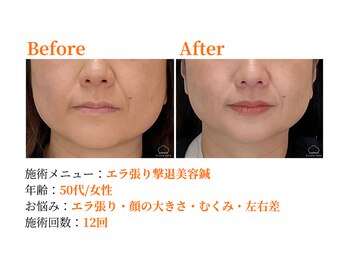 シルエラバレ(CiruelaValle)/Before After