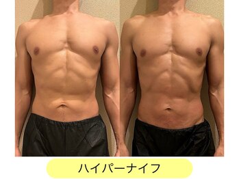 クレヴィア バイ サイバーエステ(CREBIA)/カット出し【ハイパーナイフ】