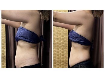 テラスアップ(Terrace UP)の写真/本気でサイズダウンを目指したい方★代謝をアップさせてスリムなボディへ導く集中ケア！限定クーポンあり◎