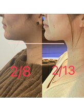 エミナル(Eminal)/◆脂肪冷却　あご　1回