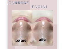 アリー(ALLY)/CARBOXY 炭酸パック