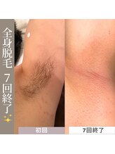 アカラビューティー(Akala Beauty)/全身脱毛〈7回目終了！！〉