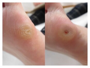 巻き爪ケアサポート ルアナ(LUANA)/Before→After