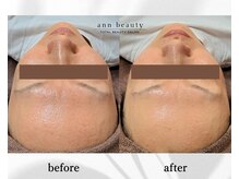 アン ビューティー(ann beauty)/施術1回【症例写真】30代女性