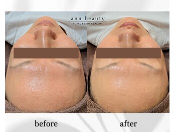アン ビューティー(ann beauty)/施術1回【症例写真】30代女性
