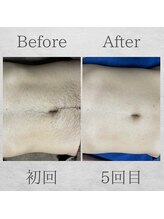 サンライズ(Sunrise)/Before After ☆