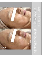シイ(total skin beaute sii)/60代　ヒト幹細胞導入　1回
