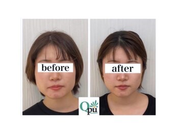 キュープ 北千住店(Qpu)/小顔頭蓋骨矯正.5