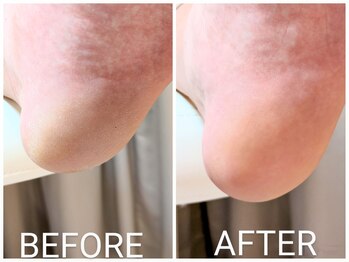 リヴィエール(Riviere)/50代男性　かかとの角質の痛み