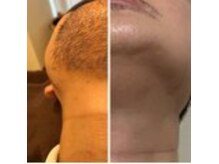 ウルル(Ululu)の雰囲気(メンズ専門ヒゲ脱毛剃刀負け対策/ビフォーアフター)