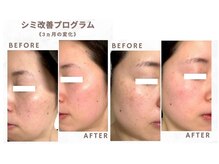 サロンソワ(salon Soi.)/ピュールボーテ：シミ改善