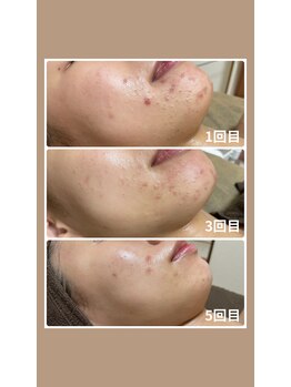 ホリホック/症例