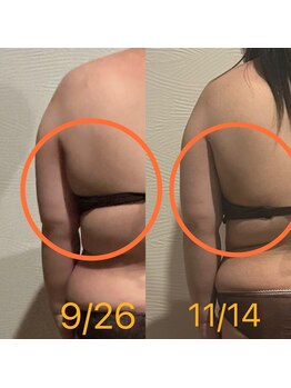 エミナル(Eminal)/◆脂肪冷却　背中　1回