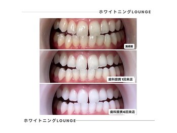 ホワイトニングラウンジ 神戸三宮店