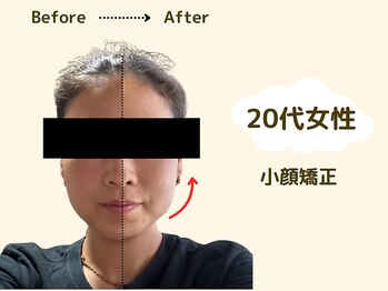 アロゼ/小顔調整　20代女性