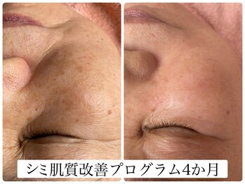 ヌー 栄(nuu)/シミ肌質改善プログラム4か月