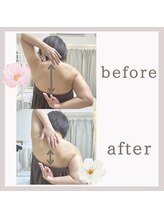 ビューティフィール アンド アリサナ(Beauty Feel&Arisana)/アリサナ症例写真　肩甲骨はがし