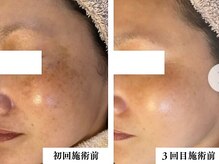 リコス(LICCO’S)/光フォト　シミケア２回