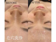 チョコバリ プラス(chocobari plus)/毛穴/黒ずみ/ハイドラ/開き毛穴