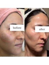 アルル(ARuru)/肌改善症例