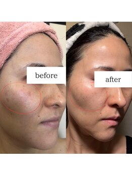 アルル(ARuru)/肌改善症例