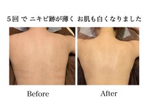 ナチュラーレ 天王寺店(Naturale)/美肌ニキビケア小顔フェイシャル