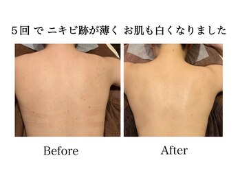 ナチュラーレ 天王寺店(Naturale)/美肌ニキビケア小顔フェイシャル