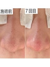 レイ エステティック 江南店(RAY ESTHETIC)/毛穴洗浄×顔脱毛