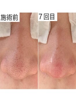レイ エステティック 江南店(RAY ESTHETIC)/毛穴洗浄×顔脱毛