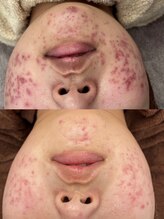 エレン(Elen)/ハーブピーリング美肌専門店ELEN