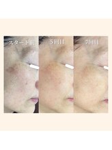毛穴専科/継続が大切！シミケア那覇