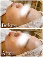 ティアラ(TIARA)/ハーブピーリング