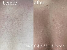 エーアール(ar)/ハーブピーリング/2Bバイオ