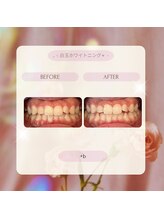 プラスビー 2号店(+b)/ホワイトニングビフォーアフター