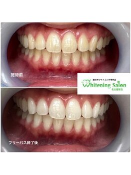 ホワイトニングサロン 名古屋駅店/【ホワイトニング施術例】
