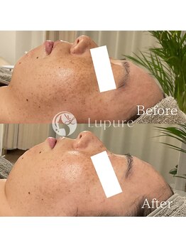 ルプレ(Lupure)/ハーブピーリング4回目