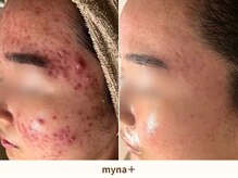 マイナプラ 表参道(myna+)/徹底したカウンセリング