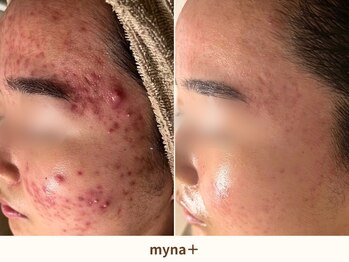 マイナプラ 表参道(myna+)/徹底したカウンセリング