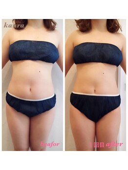 カウラ(Kaura)/上半身ビフォーアフター(肥後橋)