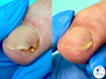 プラスワンフット 本厚木(+1 Foot)/変形・肥厚した爪を正常な爪へ