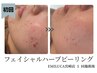 【ハーブピーリングフェイシャル】ニキビケア│陶器肌│選べるハーブ¥9600
